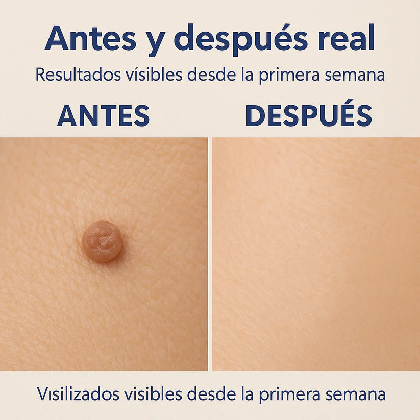 Removedor de Verrugas | Wart Remover Solution 20g