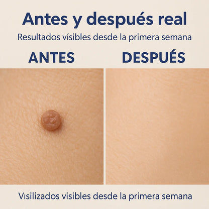 Removedor de Verrugas | Wart Remover Solution 20g